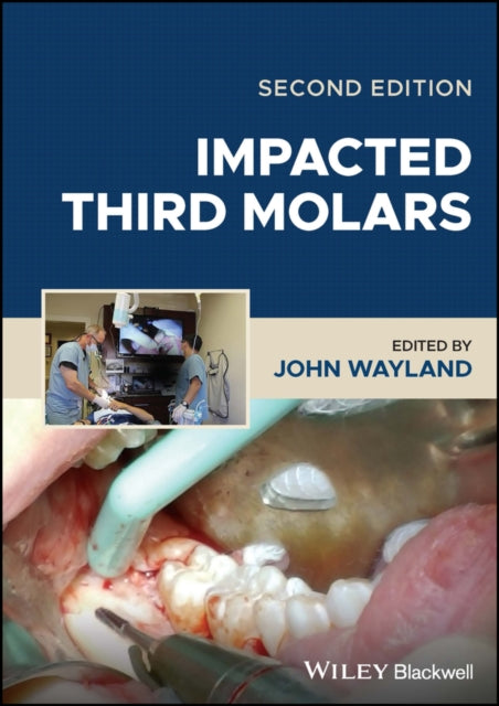 Impacted Third Molars