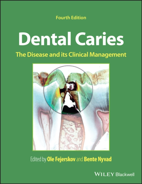 Dental Caries: The Disease and its Clinical Management