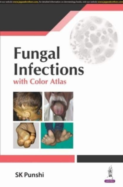 Fungal Infections: with Color Atlas