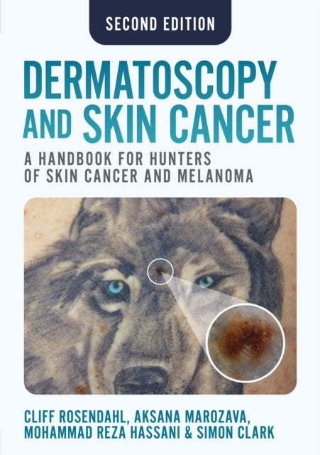 Dermatoscopy and Skin Cancer, second edition: A handbook for hunters of skin cancer and melanoma