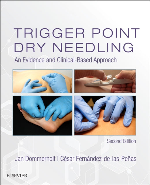 Trigger Point Dry Needling: An Evidence and Clinical-Based Approach