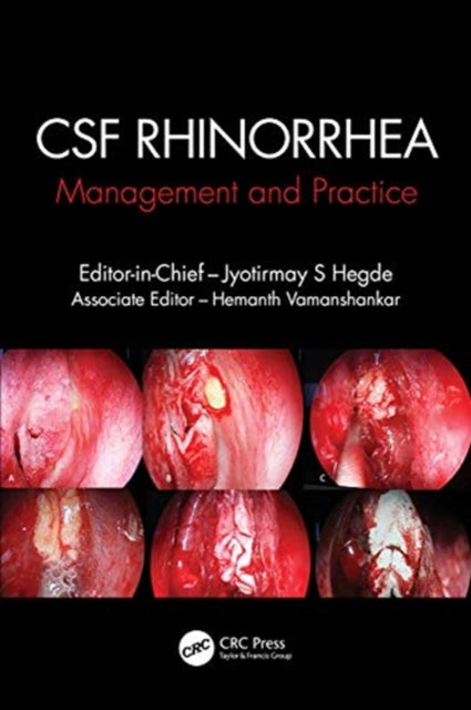CSF Rhinorrhoea: Management and Practice