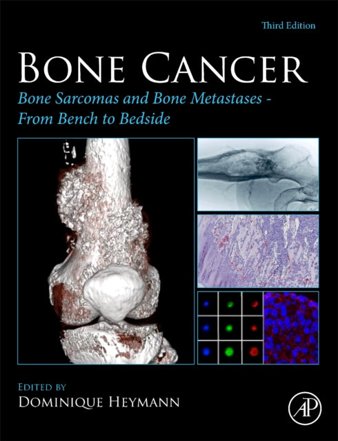 Bone Cancer: Bone Sarcomas and Bone Metastases From Bench to Bedside