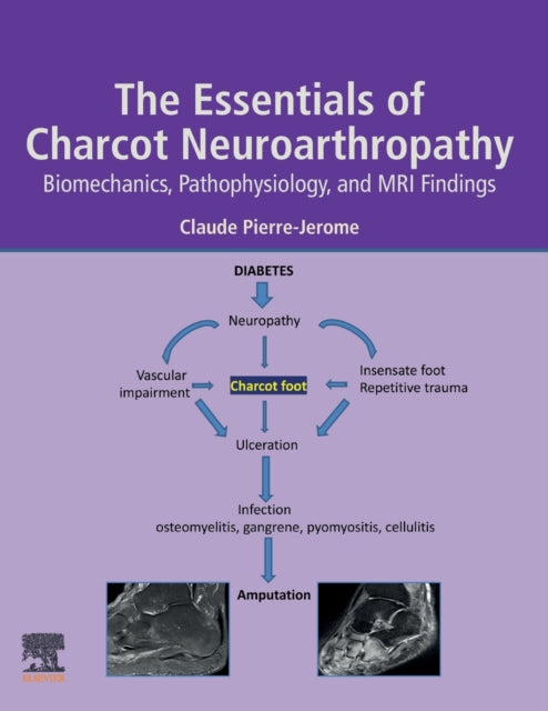 The Essentials of Charcot Neuroarthropathy: Biomechanics, Pathophysiology, and MRI Findings