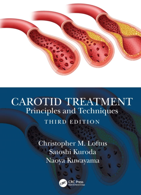 Carotid Treatment: Principles and Techniques