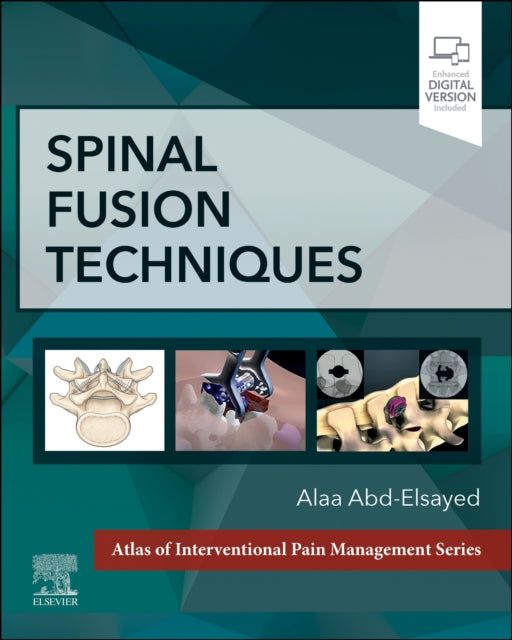 Spinal Fusion Techniques