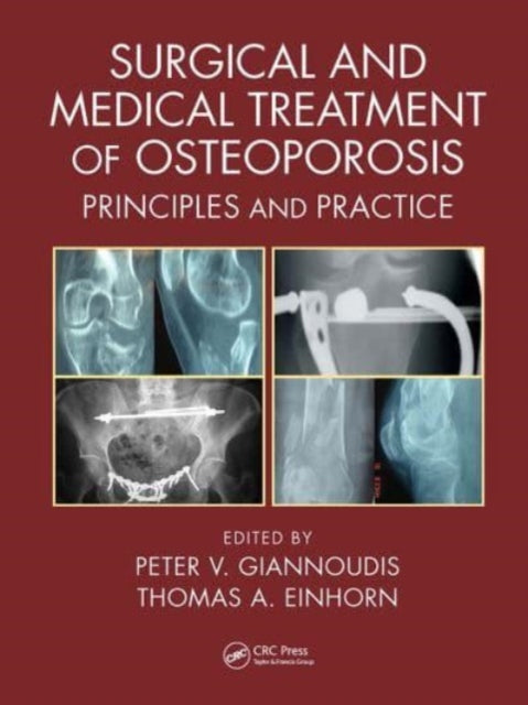 Surgical and Medical Treatment of Osteoporosis: Principles and Practice