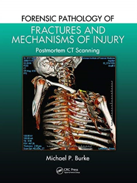 Forensic Pathology of Fractures and Mechanisms of Injury: Postmortem CT ...