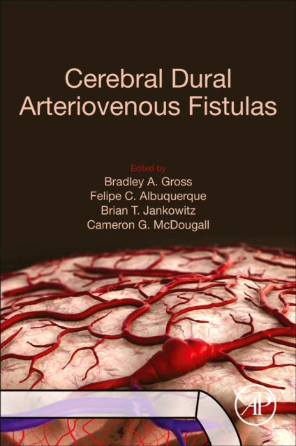 Cerebral Dural Arteriovenous Fistulas