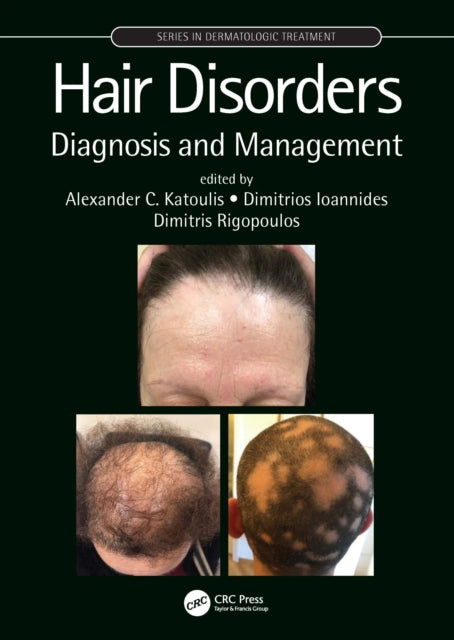 Hair Disorders: Diagnosis and Management